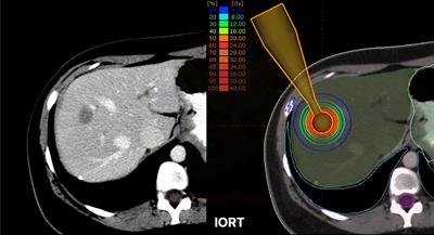 Dosimetric Comparison of Intraoperative Radiotherapy and SRS for Liver Metastases